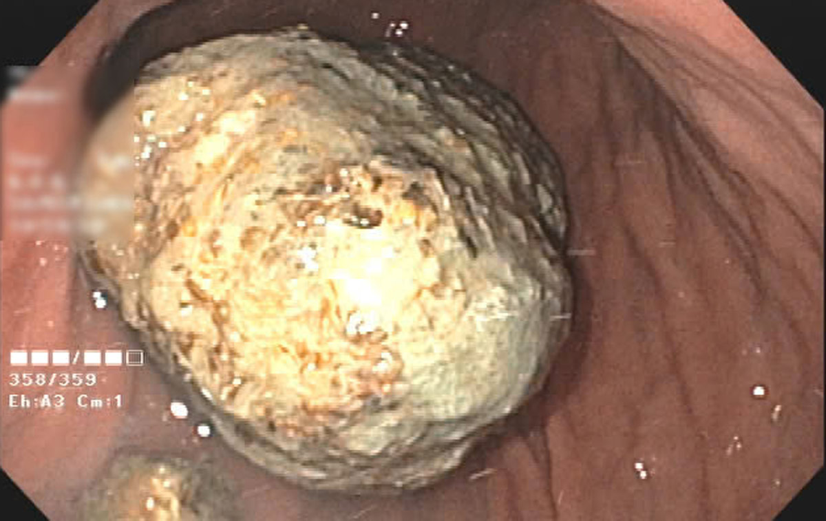 Image of large food waste through endoscopy. Photo: Bai Chay Hospital