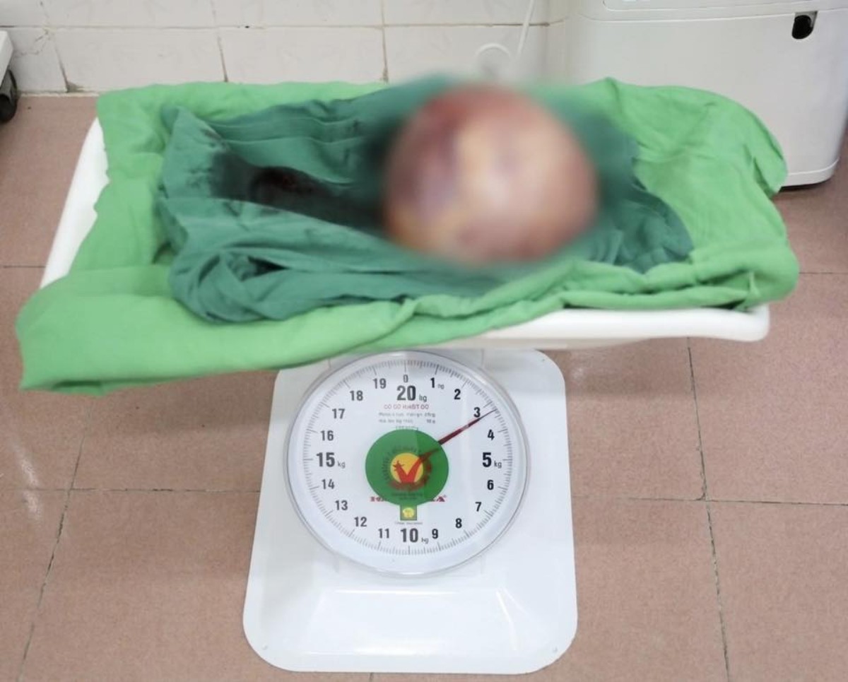 Large uterine fibroid tumor equivalent to a 7-month fetus. Photo: Nam Dinh Obstetrics and Gynecology Hospital, Ninh Binh province