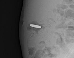 5-year-old boy in Quang Tri swallows a coin in his stomach. Photo: Quang Tri Friendship Hospital