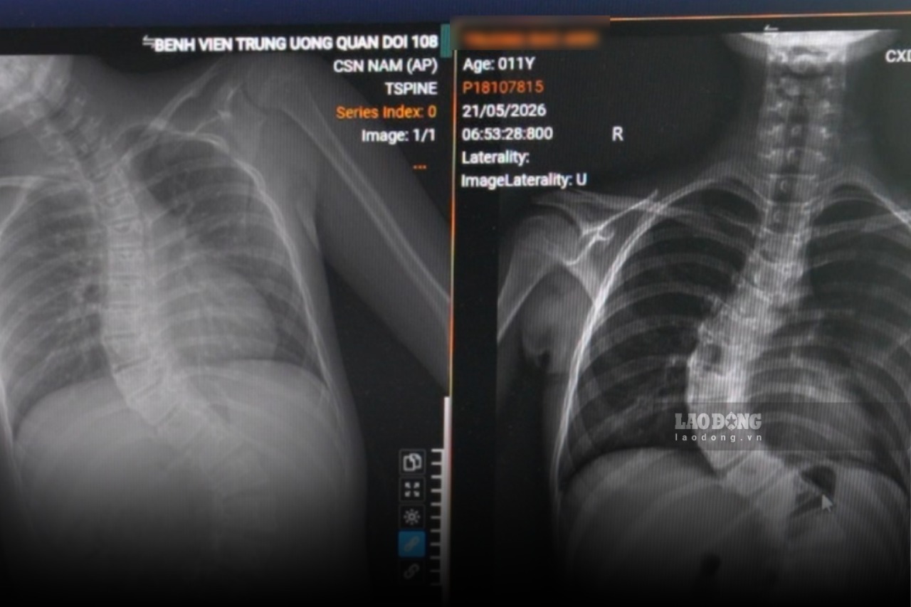 Meaningful program to help children with scoliosis detected and treated early