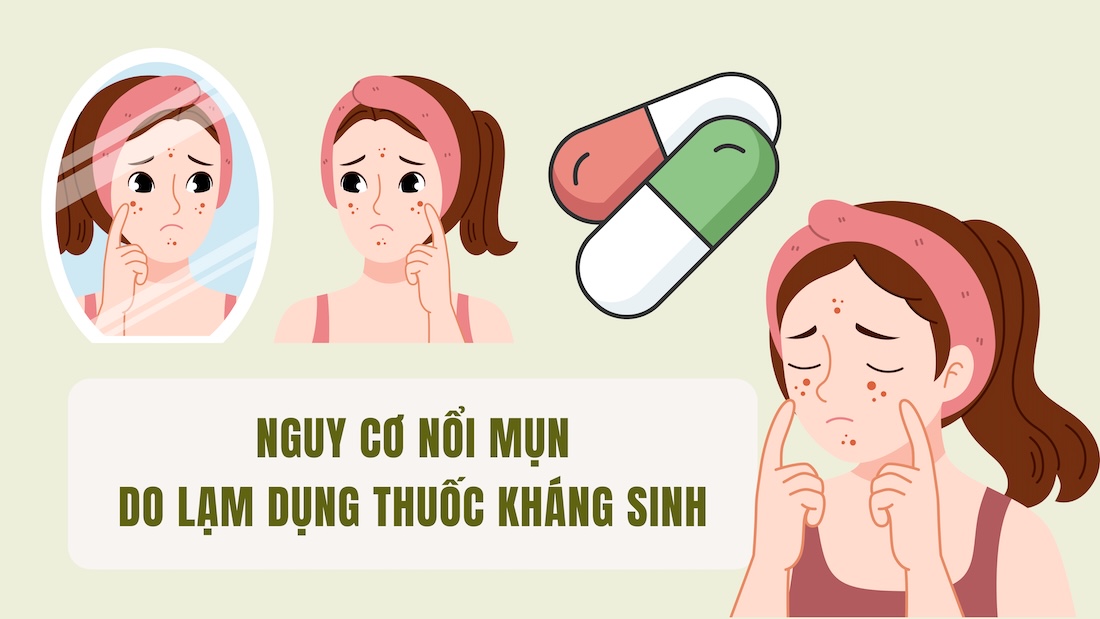 Risk of acne due to antibiotic abuse