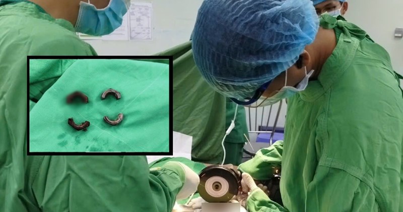 Phẫu thuật gỡ 2 bu-lông cấy vào "cậu nhỏ