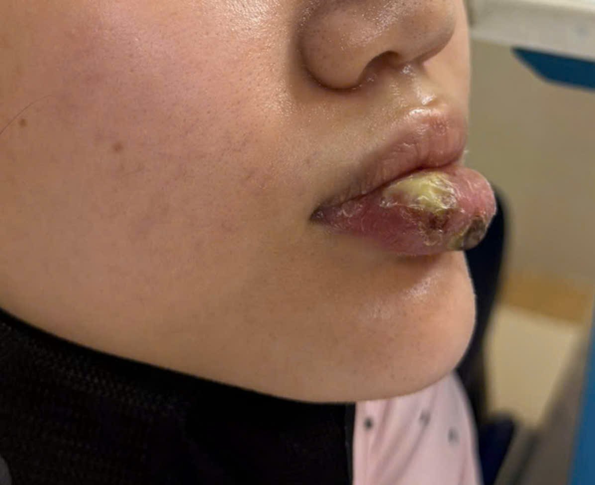 Injecting filler at an underground spa, an 18-year-old girl almost had lip necrosis. Photo: BVCC