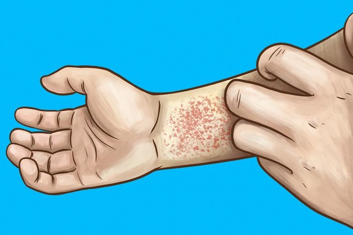 Dry and itchy skin is a sign that the kidneys cannot maintain a balance of minerals and appropriate nutrients. Photo: Thanh Van