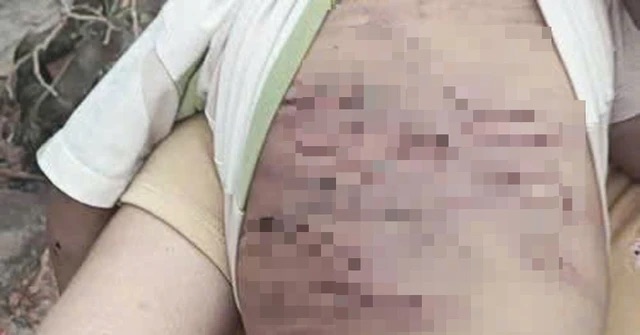 2-year-old boy abused by stepfather and biological mother in Ho Chi Minh City. Photo: People provided