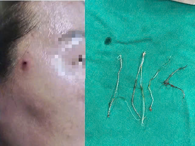 Patients with cosmetic complications due to thread lift at unsafe spas. Photo: BVCC
