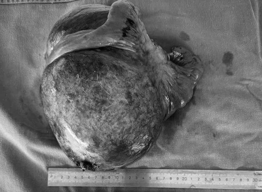 巨大な小腸腫瘍が男性の左腹部の半分を占める。写真:BVCC
