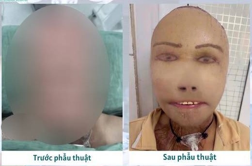 Bệnh viện Đa khoa Bình Dương đang nỗ lực tái tạo lại khuôn mặt cho bệnh nhân. Ảnh: Bệnh viện cung cấp