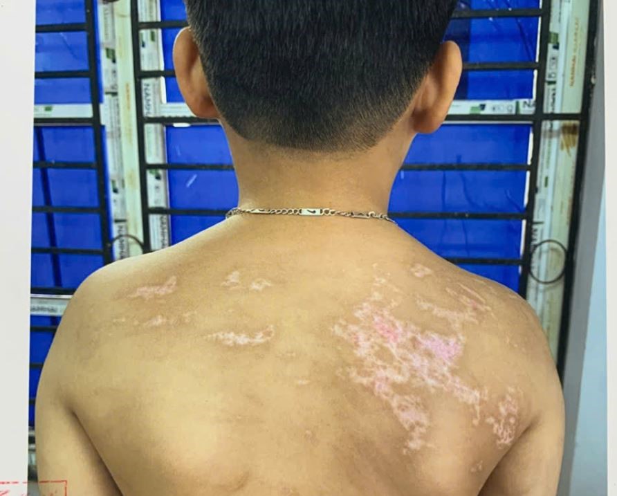 Nhiều vết thương trên người cháu bé ở Phú Thọ. Ảnh: Công an Phú Thọ
