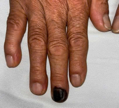 Image of fingernail melanoma cell cancer. Photo: Dr. Nguyen Huu Quang