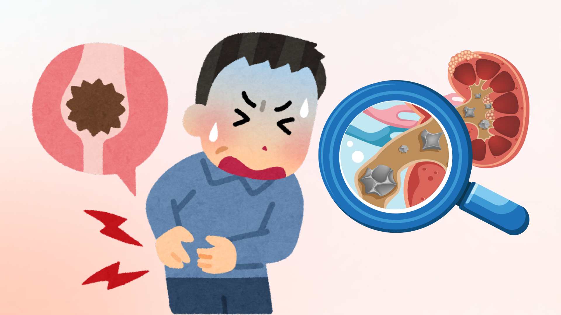 Patients with kidney stones need to avoid 4 food groups that easily make the disease worse