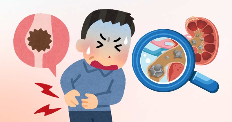 Bệnh nhân sỏi thận cần tránh 4 nhóm thực phẩm làm bệnh nặng hơn