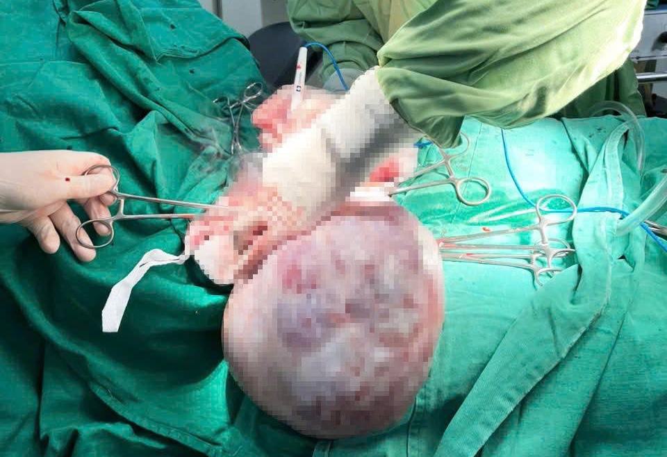 14歳の少女が腹部に約30cmの巨大な腫瘍を抱えています。写真:BVCC
