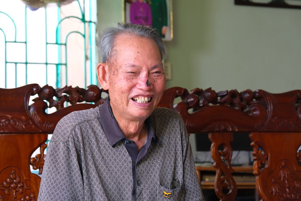 Ông Hoàng Dũng và vết mổ lần thứ 2 từ di chứng bệnh ung thư nhưng vẫn lạc quan. Ảnh: Lục Tùng.