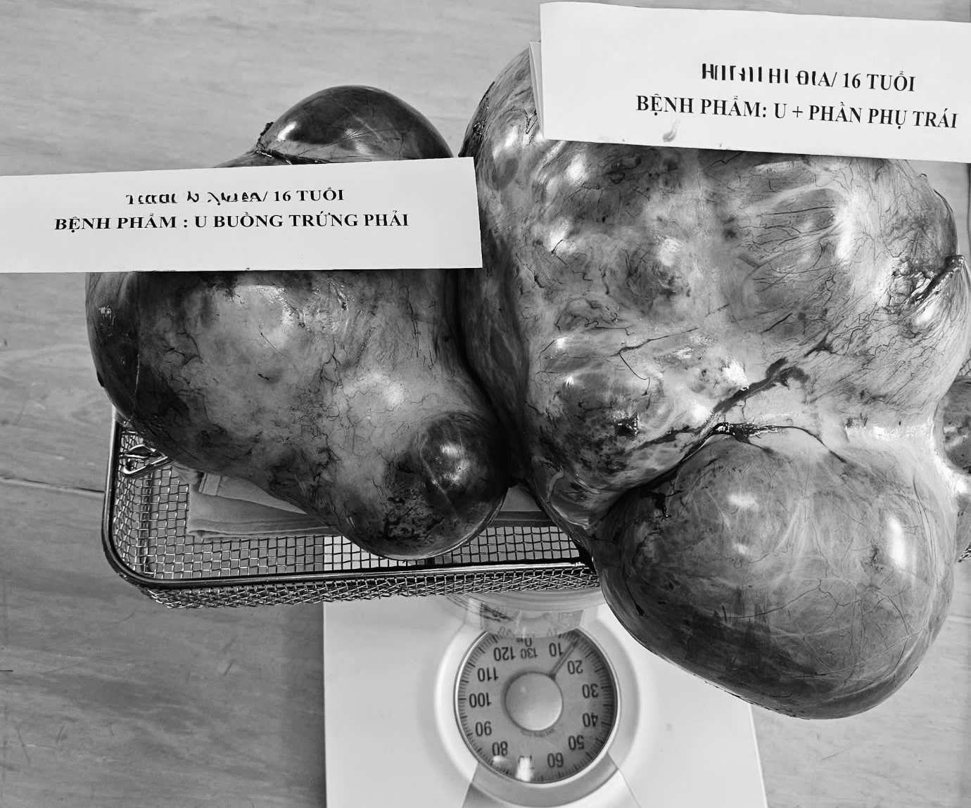 El tumor de casi 15 kg fue extirpado quirúrgicamente. Foto: Tran Ha