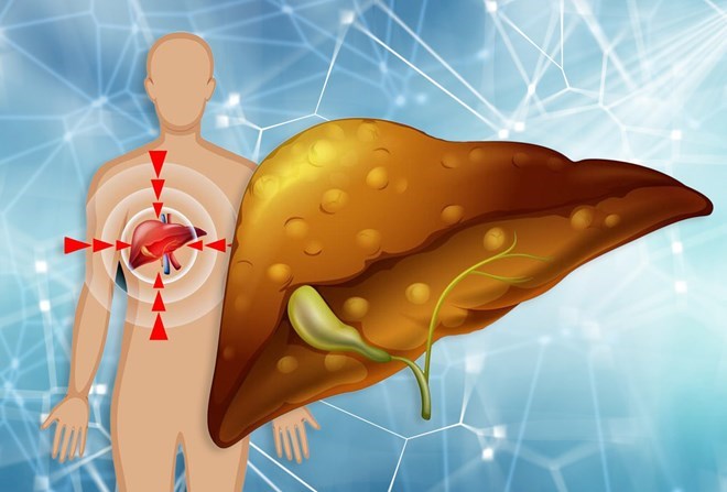 Lifestyle changes can improve fatty liver conditions. Graphics: Vu Linh