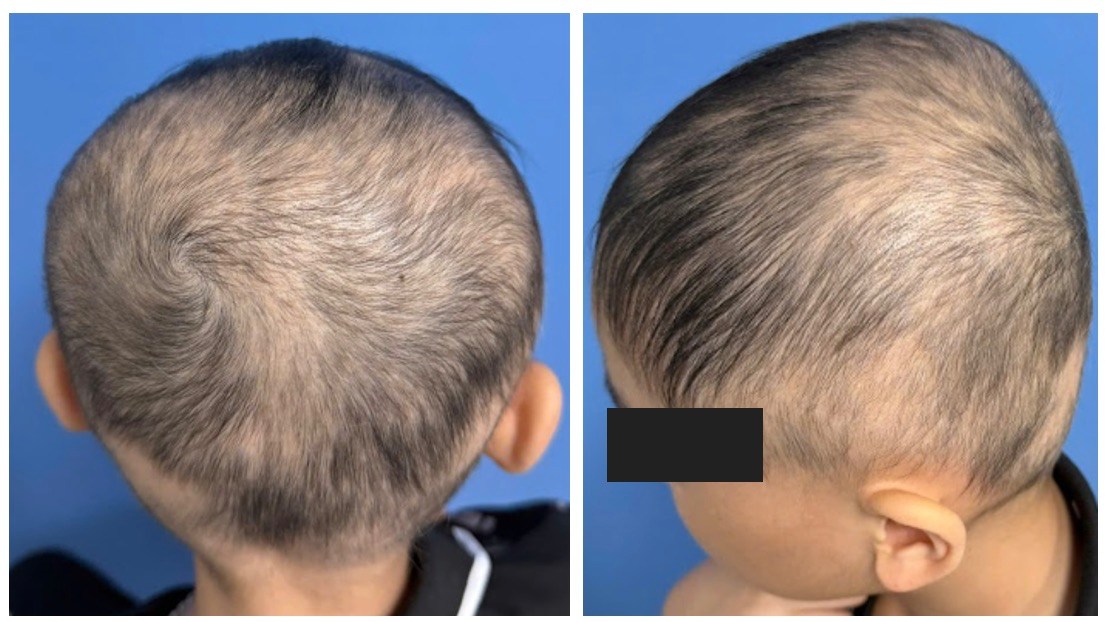 Bệnh nhi 10 tuổi bị rụng tóc toàn bộ 3 năm, nay đã bắt đầu mọc lại sau điều trị. Ảnh: BVCC
