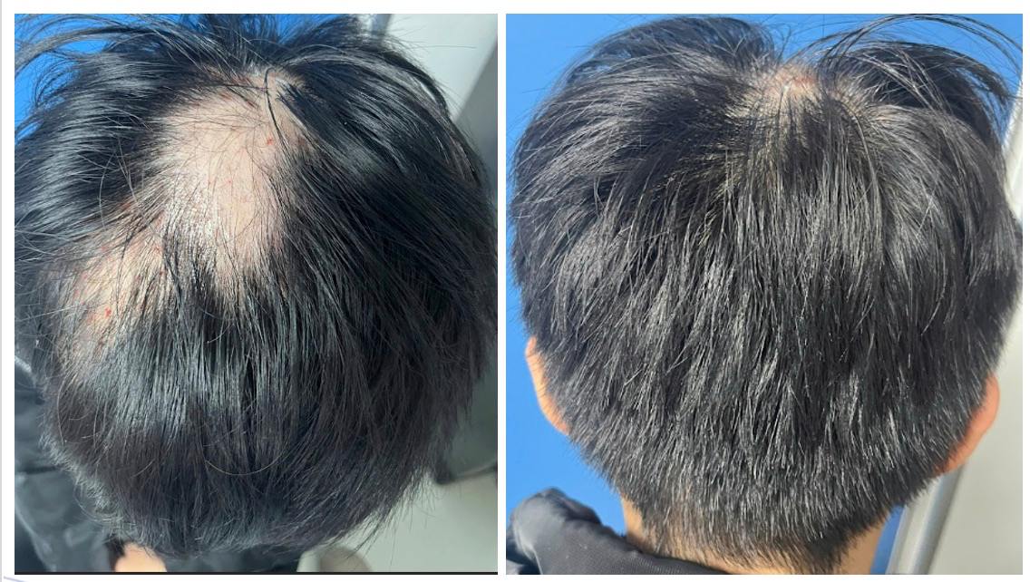 De nombreux jeunes souffrent de perte de cheveux, de calvitie en grandes plaques et doivent se rendre à l'hôpital pour se faire soigner. Photo: BVCC