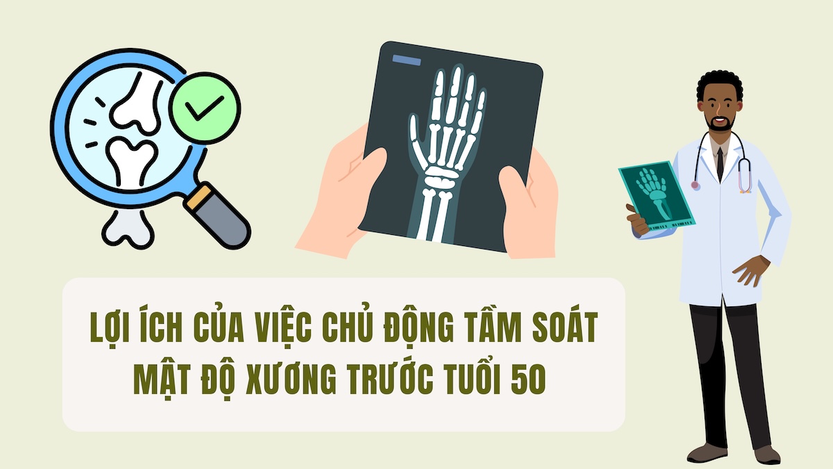 Benefits of proactive bone density screening before age 50