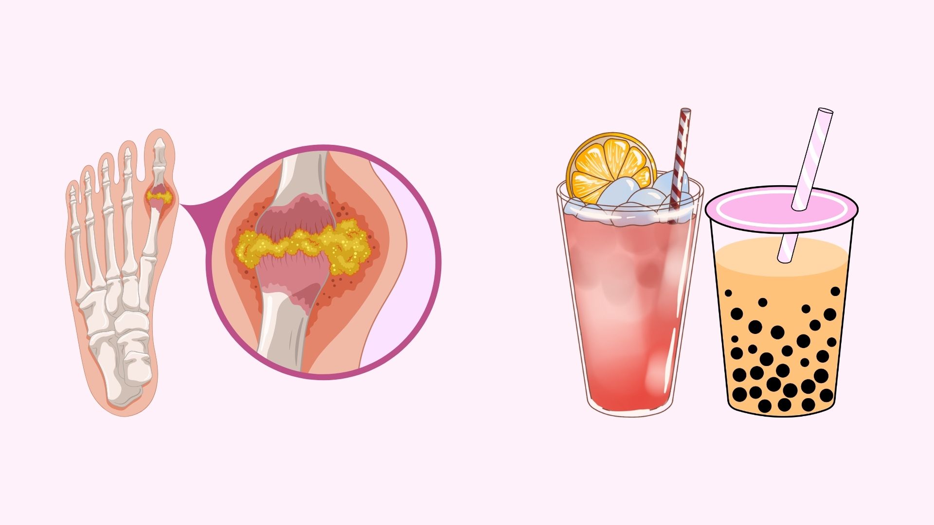 Uric acid can be elevated due to the habit of using certain types of drinks. Graphics: Minh Chau