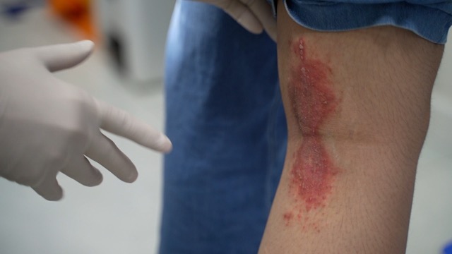 When attacked by ants, people should remain calm, use paper or thin objects to gently remove ants from their bodies. Photo: Nguyen Ly