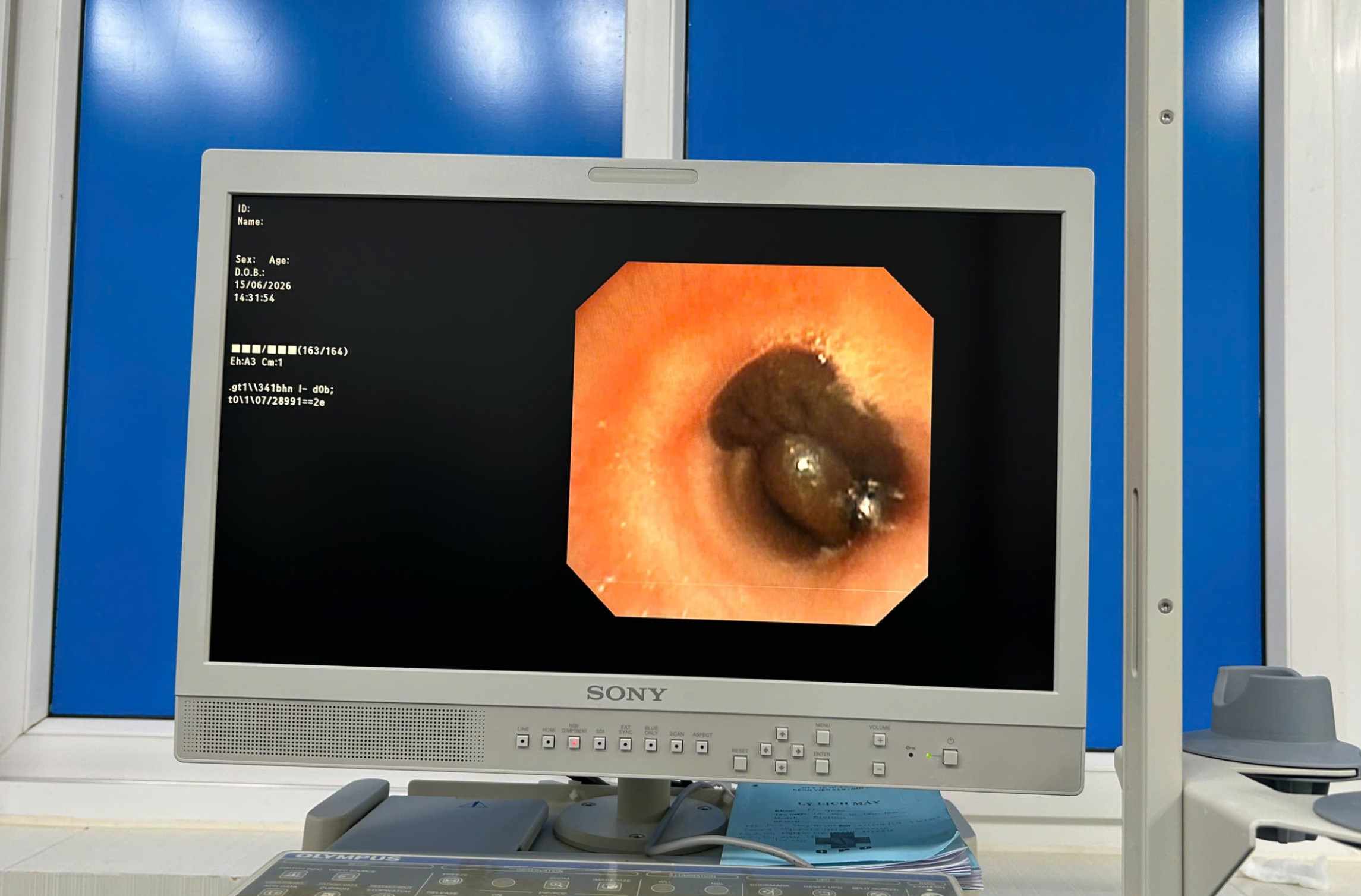Doctors discovered a leech clinging to the patient's airway. Photo: Kim Ny