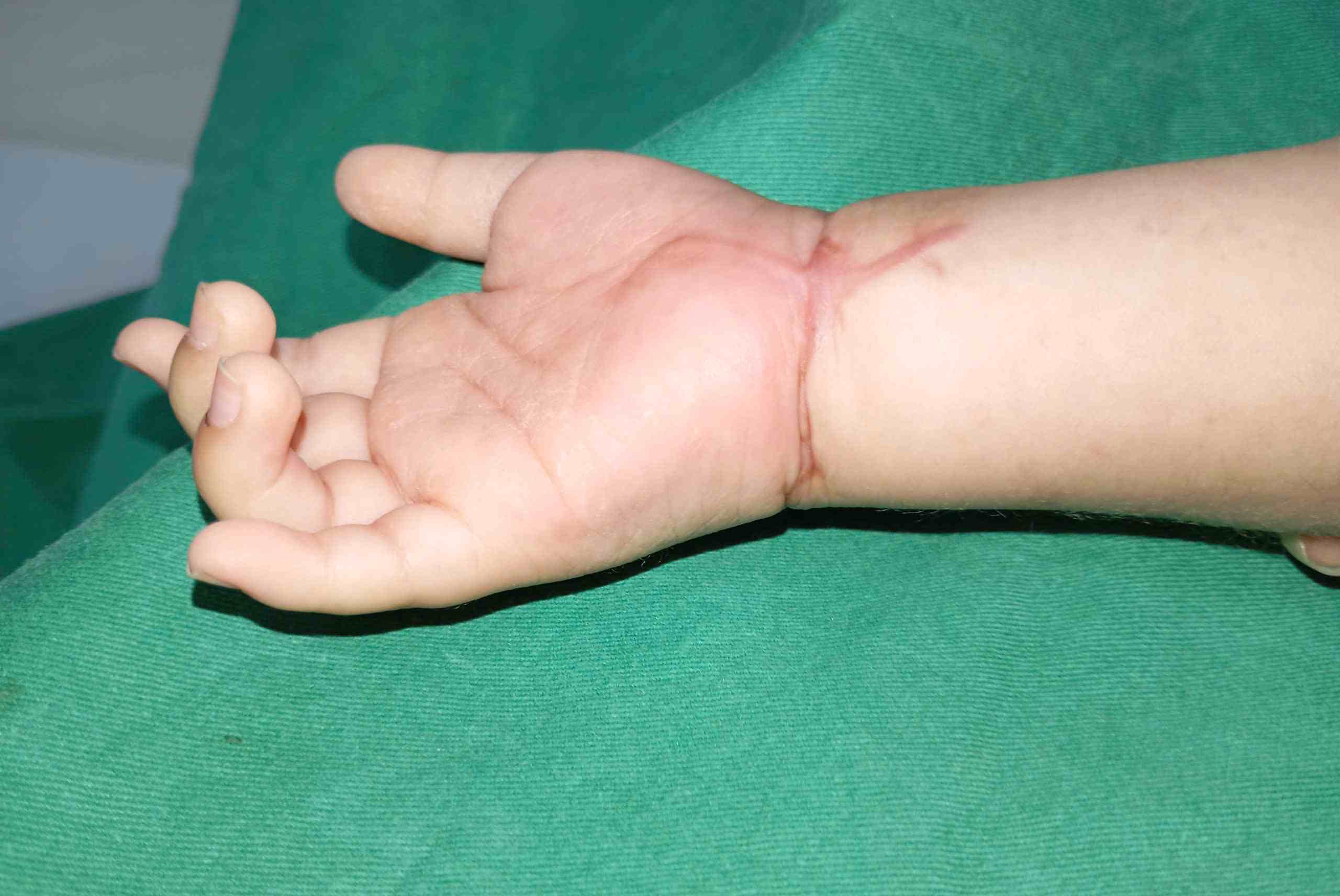 Reconstrucción exitosa de la mano casi cortada de un niño de menos de 2 años. Foto: BVCC