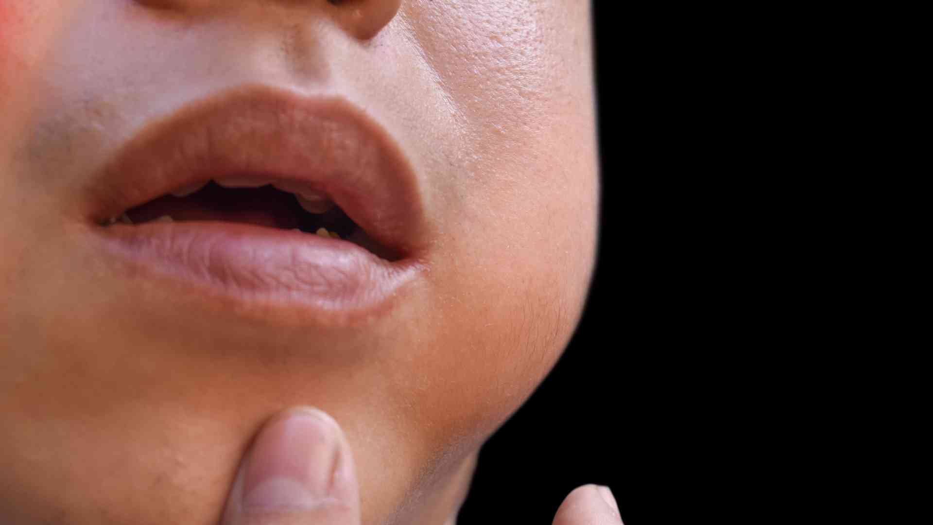 The most characteristic manifestation of mumps is parotitis. Photo: BVCC