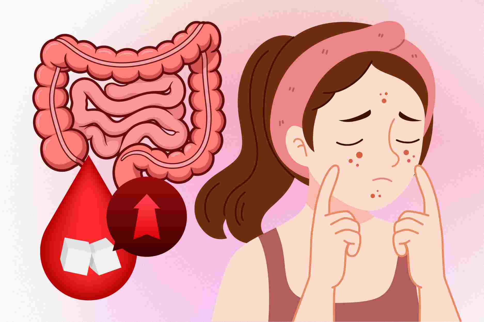 How intestines, hormones and blood sugar affect the skin
