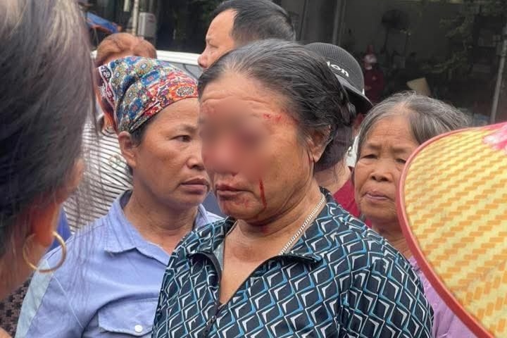 Bà Quyết bị xịt nước dẫn đến chảy máu mắt. Ảnh: Mạng xã hội