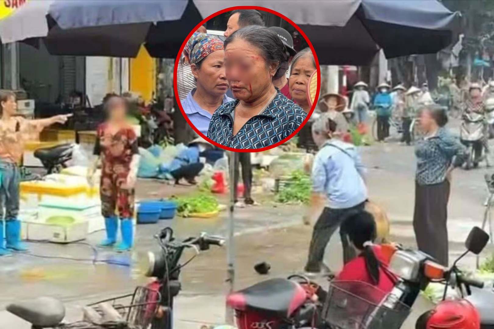 Người phụ nữ bị xịt nước dẫn đến chảy máu mắt, phải điều trị ở bệnh viện. Ghép ảnh: T.C