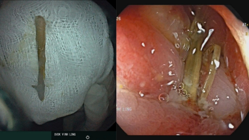 Laparoscopic surgery helps to promptly treat intestinal obstruction due to rectal tumors and foreign objects piercing the colon. Photo: Vinh Long General Hospital