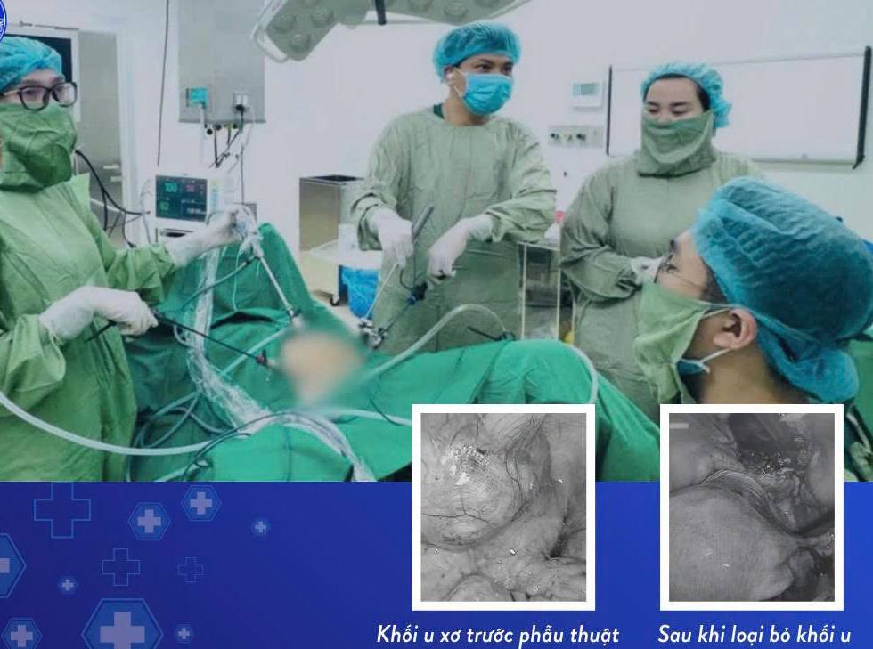 Doctors perform surgery on uterine fibroids. Photo: BVCC