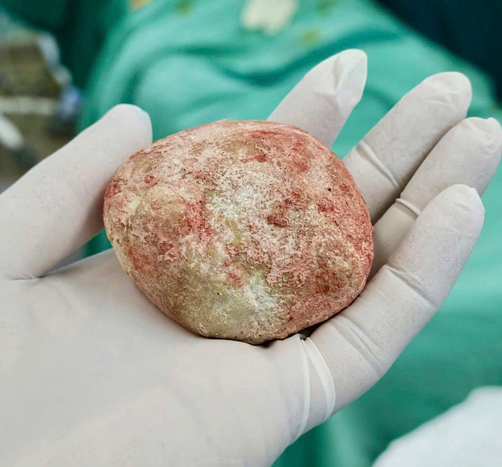 200 gram bladder stones in the abdomen of a 12-year-old child. Photo: Vietnam-Cuba Friendship Hospital Dong Hoi