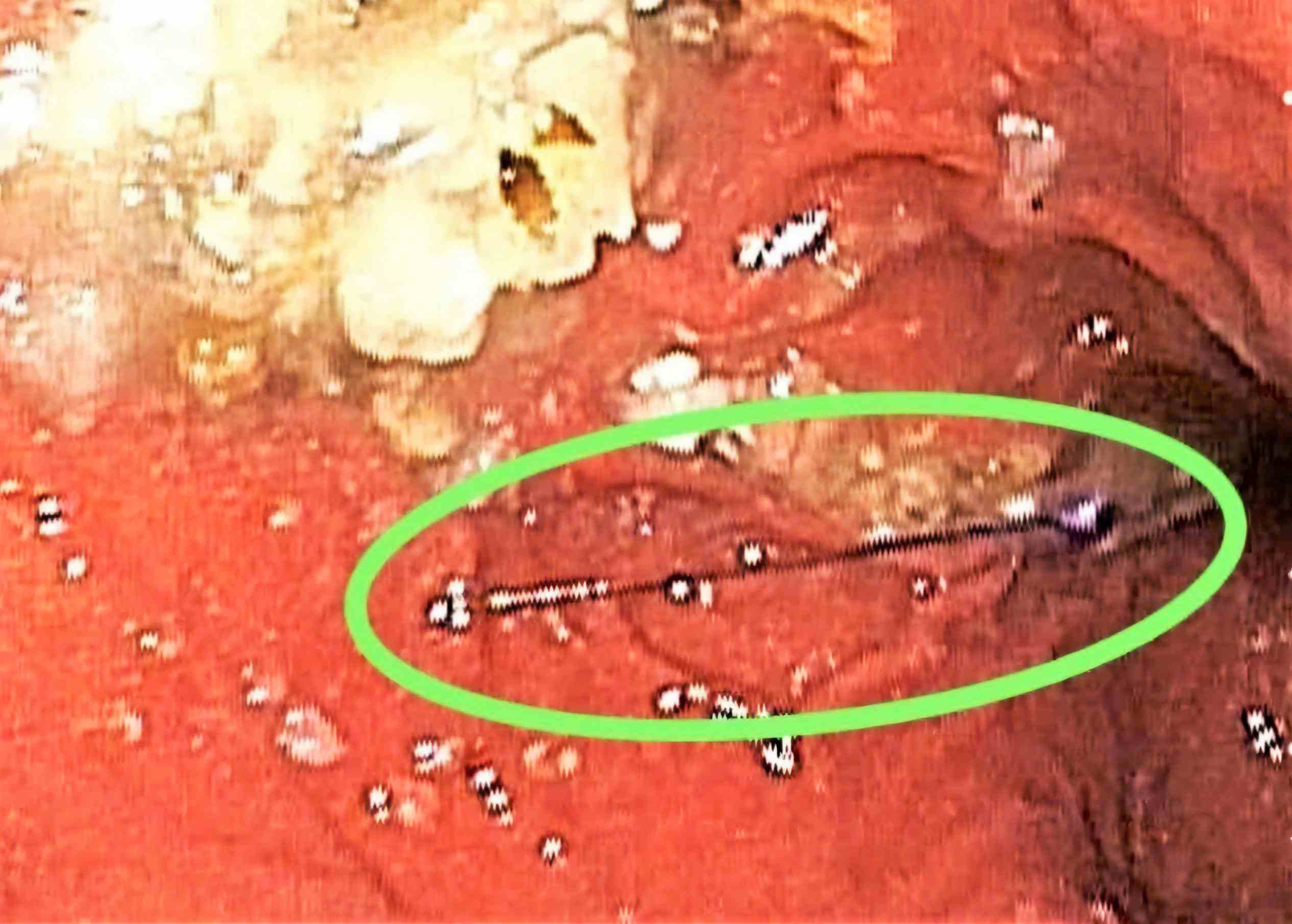Sharp foreign object discovered inside the stomach of a 10-year-old boy. Photo: Lam Dong General Hospital