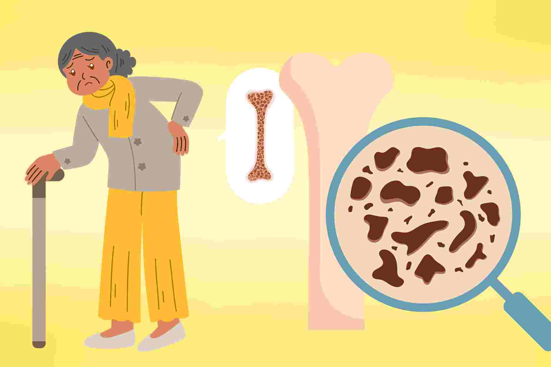 How to prevent the risk of osteoporosis in the elderly