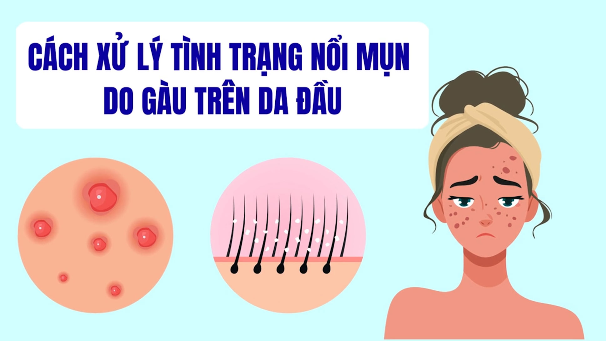 How to treat acne due to dandruff on the scalp.