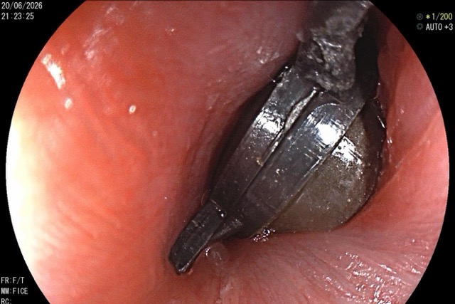El cuerpo extraño fue descubierto por los médicos y extraído con éxito para el paciente pediátrico. Foto: BVCC