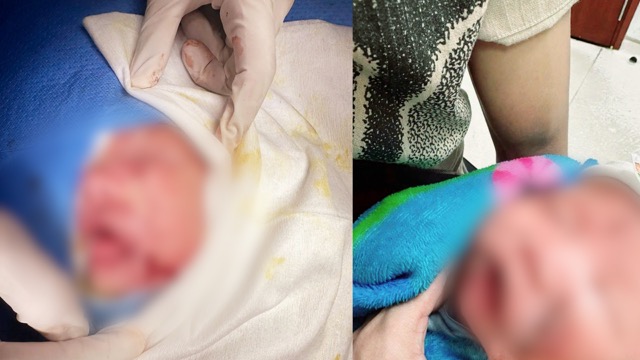 Pediatric patient with hemangioma successfully operated on by doctors. Photo: BVCC