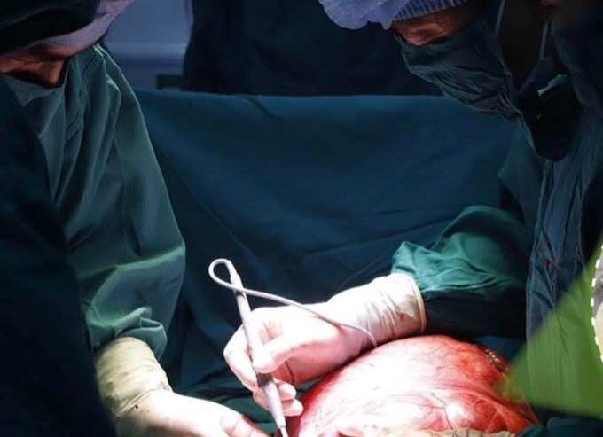 子宮筋腫の手術。写真:BVCC
