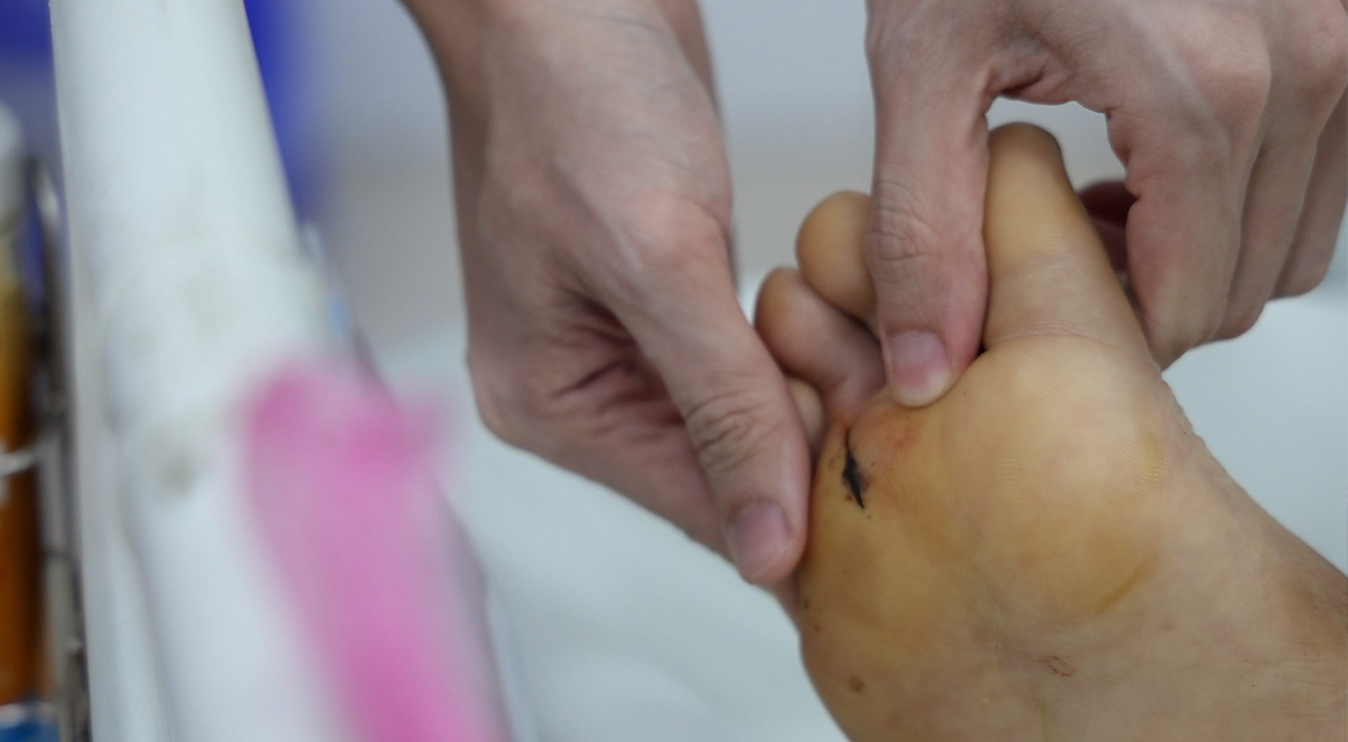 Vết thương ở bàn chân của nam bệnh nhân sau khi dẫm phải đinh trong lúc làm việc tại công trường. Ảnh: Dương Anh
