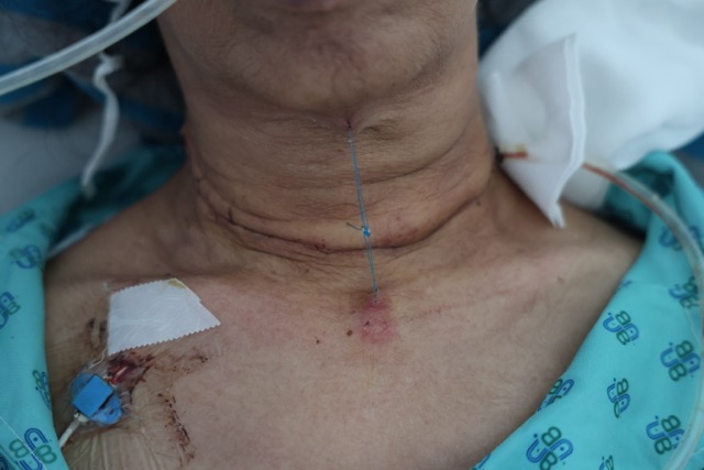 Rare endotracheal invasive thyroid cancer patient. Photo: BVCC
