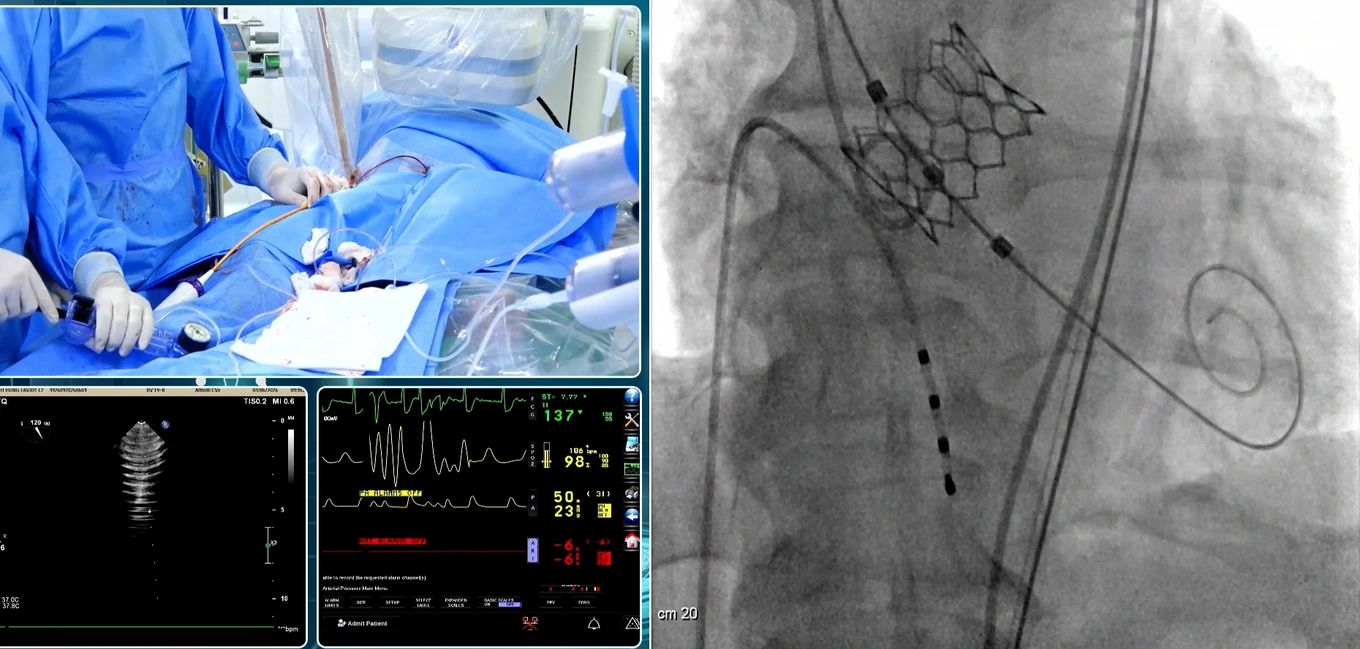 Severe heart valve stenosis, patient discharged after a few days thanks to minimally invasive technique. Photo: BVCC
