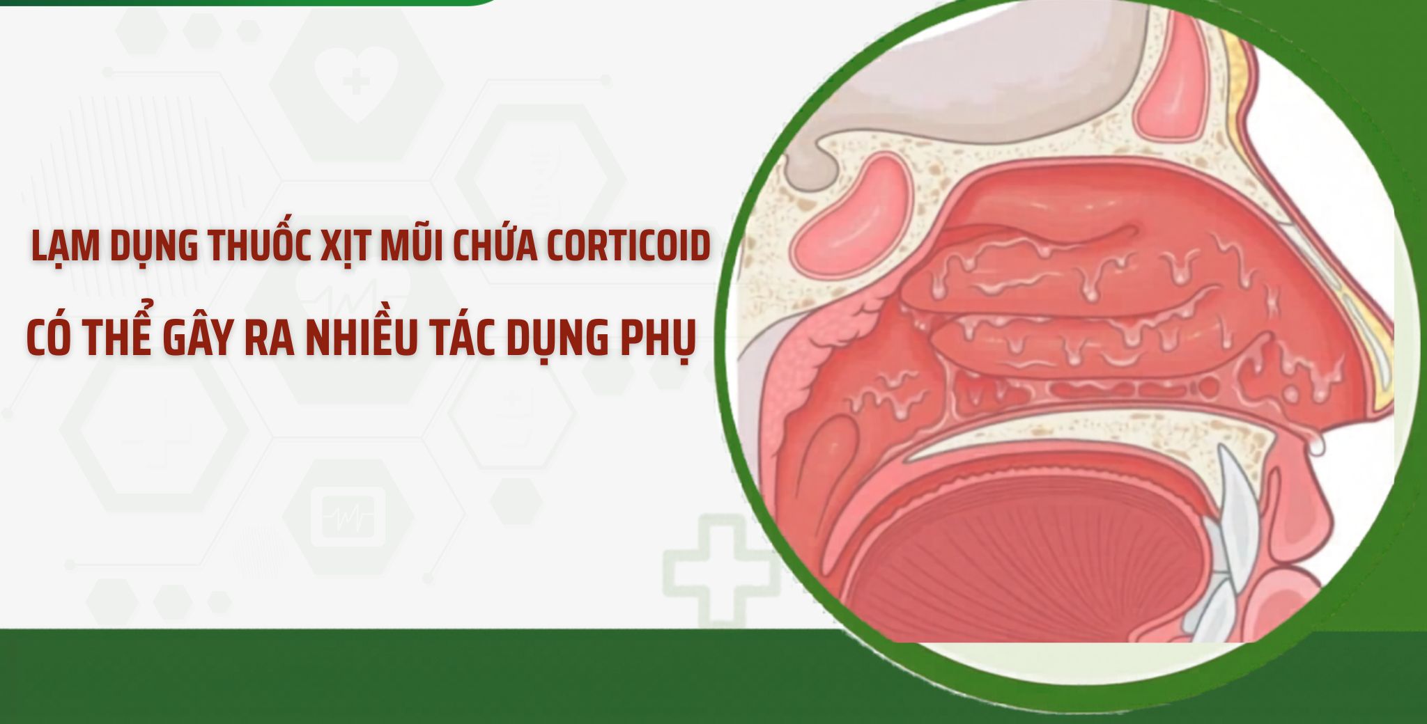 Complications due to abuse of nasal sprays containing corticosteroids. Photo: BVCC
