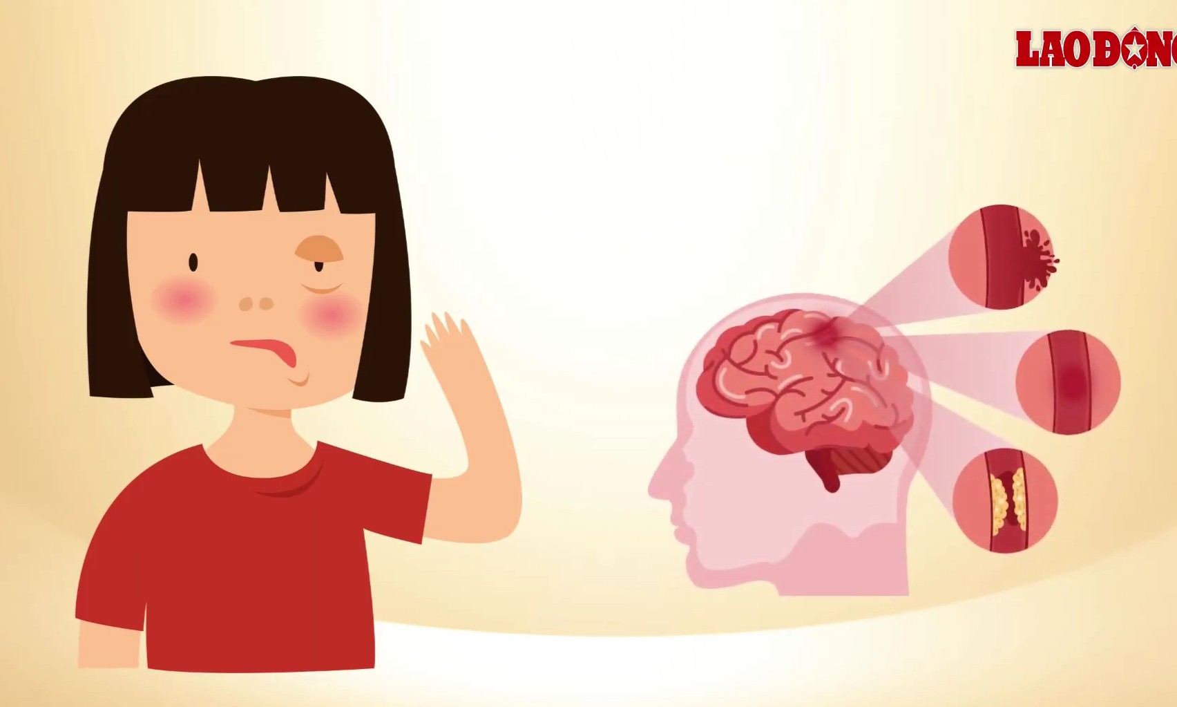 Facial manifestations warning of stroke