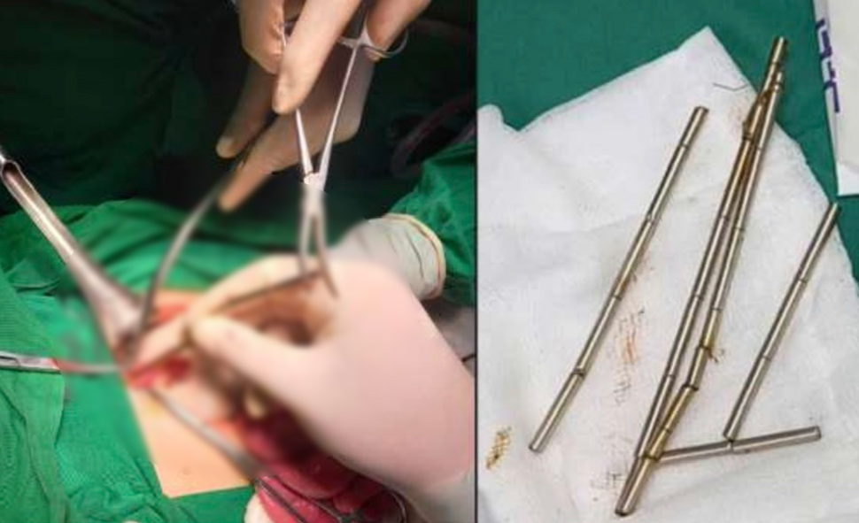 Doctors at Gia Lai Central General Hospital successfully performed surgery to remove 25 magnets from the digestive tract of a 13-year-old child. Photo: Hospital
