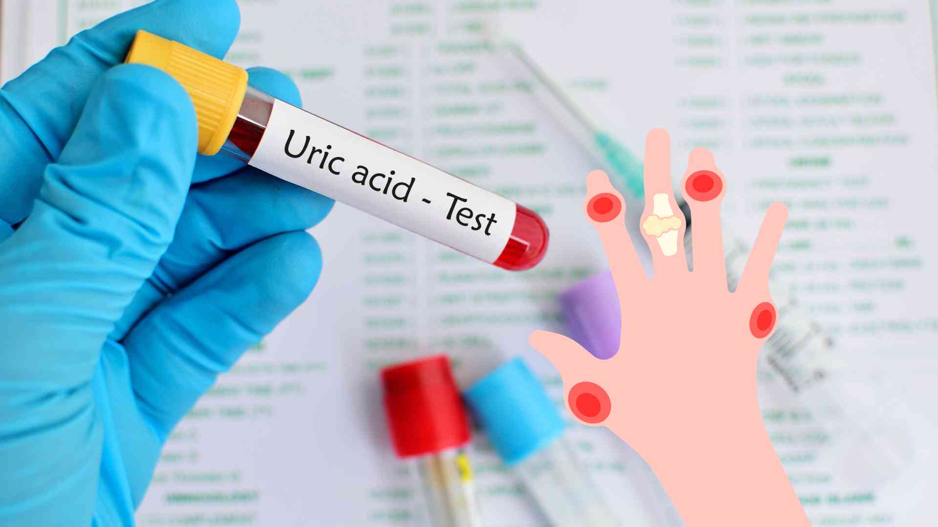 Overweight and obesity are considered one of the factors that increase the risk of increased uric acid and gout. Graphic photo: Huong Son