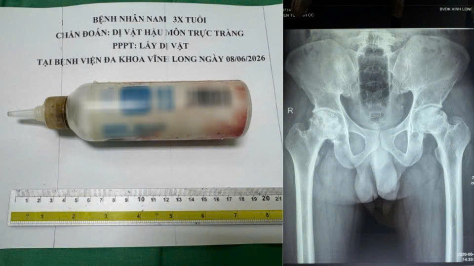 The rectal foreign object is a 20cm plastic bottle, the male patient had to undergo emergency surgery. Photo: Vinh Long General Hospital