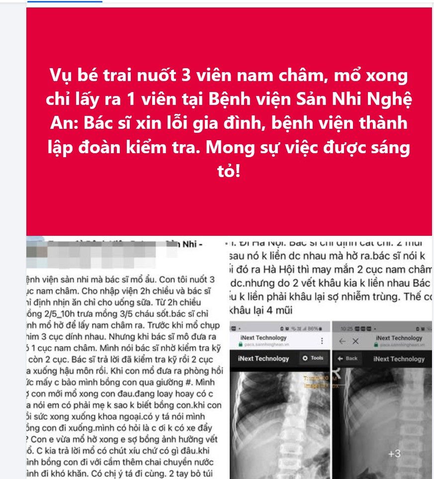 Information about children swallowing magnets for treatment at Nghe An Obstetrics and Pediatrics Hospital is spreading on social networks. Photo: Ngoc Anh