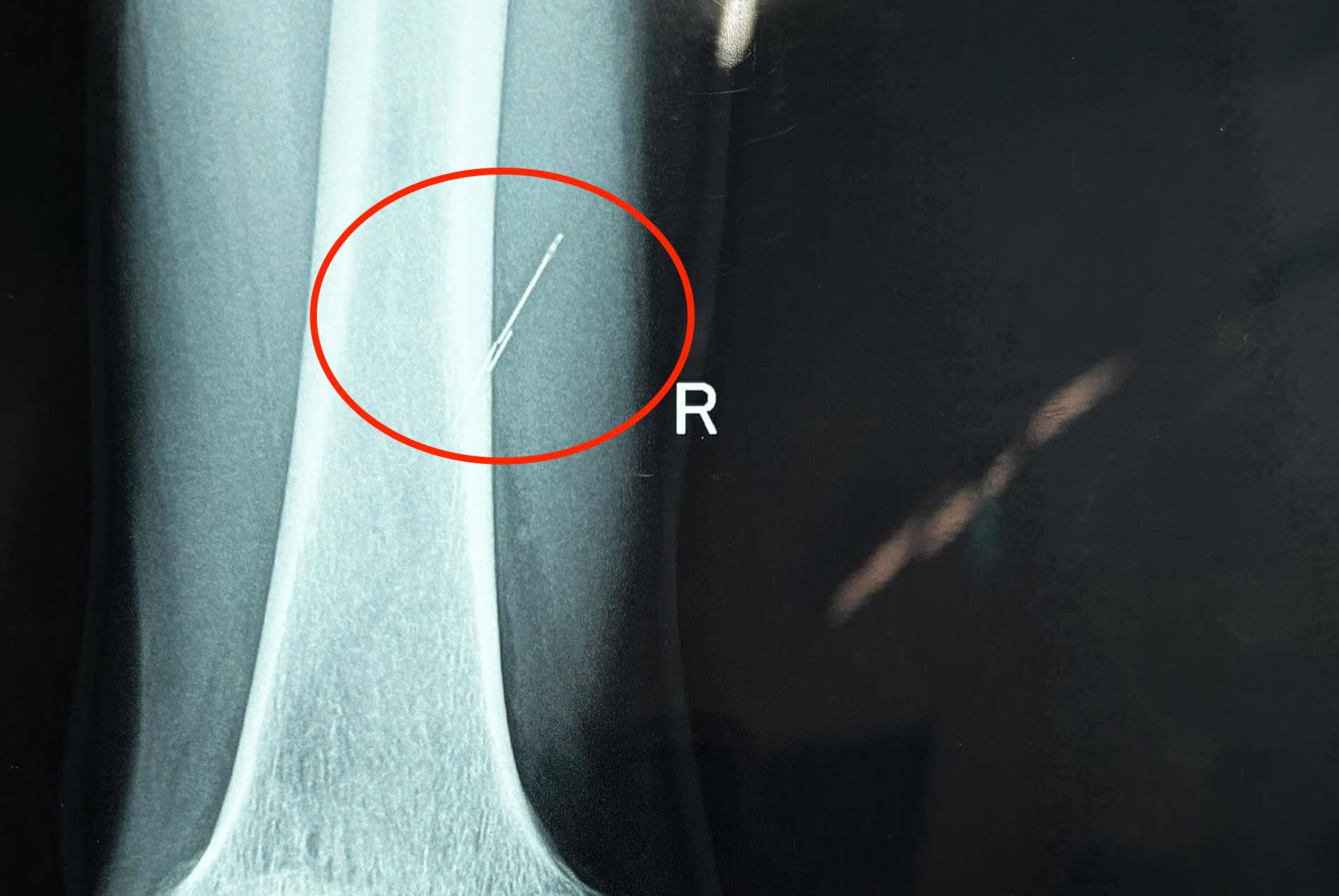 Doctors discover the sewing needle close to the man's femur. Photo: Le Thuy Regional General Hospital